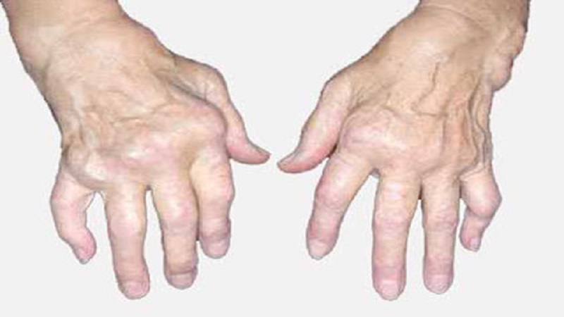 روماتیسم مفصلی