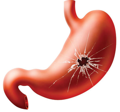 زخم معده