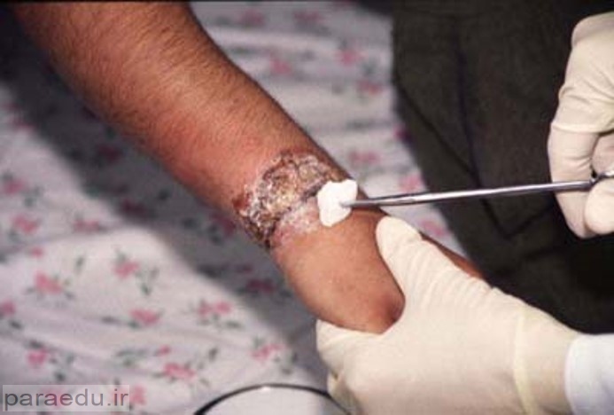 بیماری سالک؛ هر آنچه درباره آن باید بدانید! 6 نمونه برداری و تشخیص سالک
