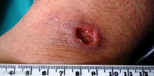 بیماری سالک؛ هر آنچه درباره آن باید بدانید! 5 paraedu ir leishmaniasis 5
