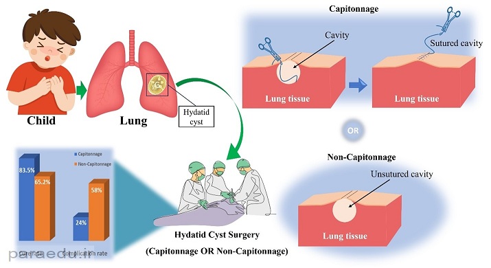 روش های جراحی در کیست هیداتید ریوی در کودکان